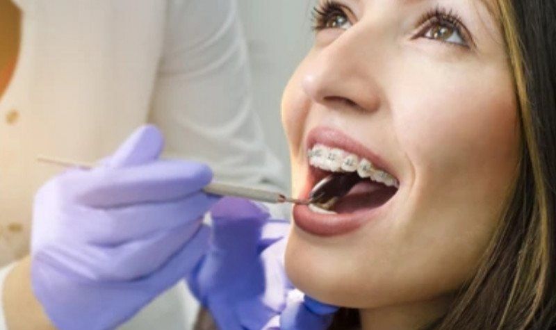 podiumnews.com-Wajib di Baca, Ini Kesalahan Pengguna Behel