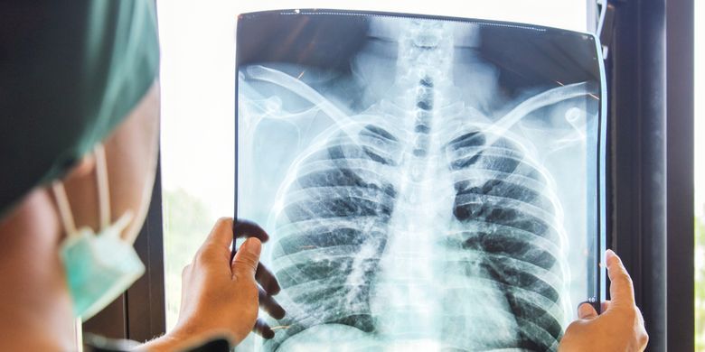 podiumnews.com-Lapas Darurat TBC! Penularan 10 Kali Lipat