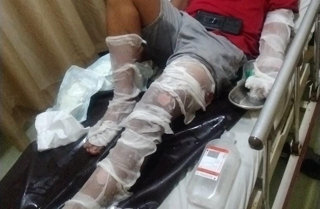 podiumnews.com-Jadi Korban Ledakan Petasan Rakitan Sendiri