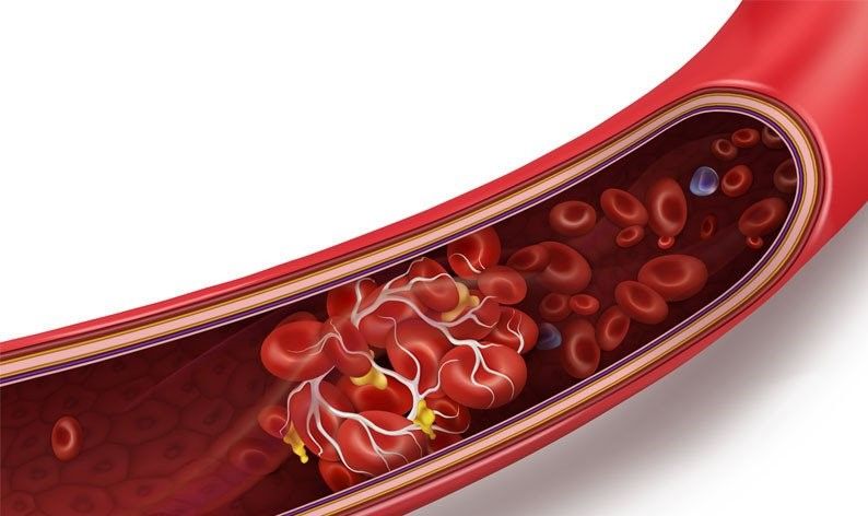 podiumnews.com-Inggris Temukan 30 Kasus Pembekuan Darah Terkait Vaksin Astrazeneca